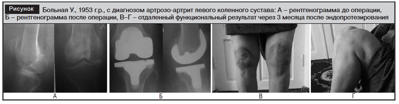 Что можно делать и что запрещено после операции по замене сустава - Nordorthopaedics